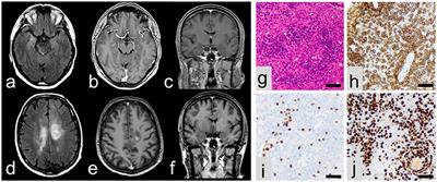 Primary B Cell Lymphoma of the CNS Mimicking Anti-LGI1 Limbic Encephalitis